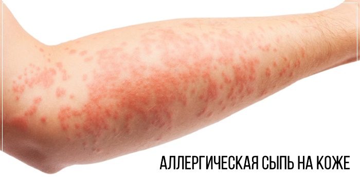 Ихтиоловая мазь может спровоцировать аллергическую сыпь