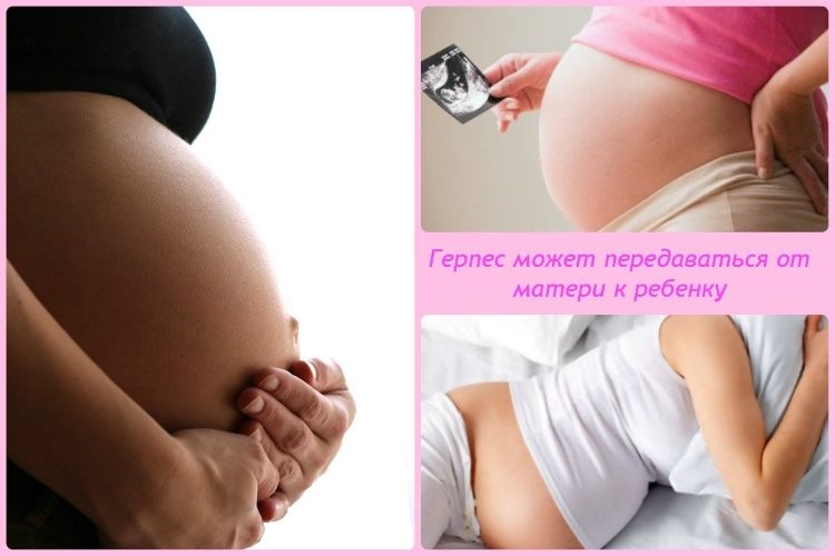 Ацикловир акрихин при беременности запрещена