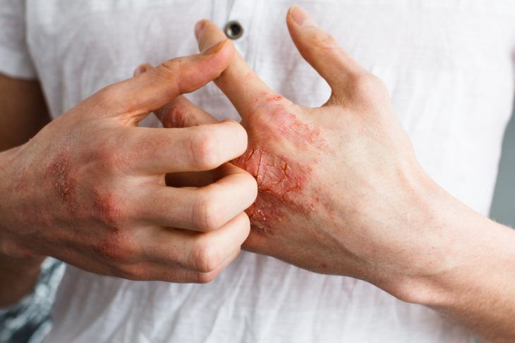 Препарат используют для лечения инфекционно-воспалительных болезней кожи