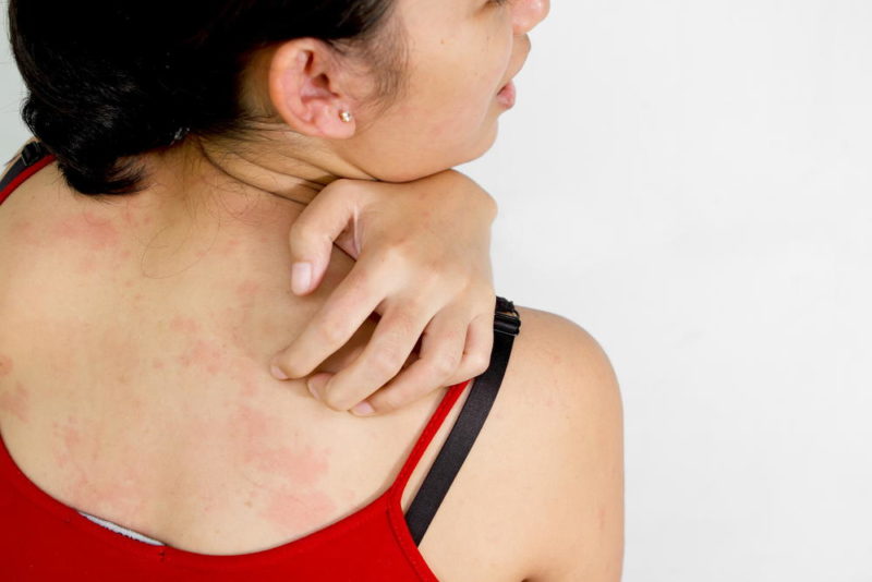 Аллергическая сыпь - побочное действие препарата 