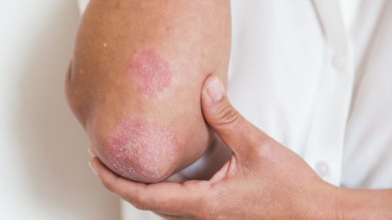 Препарат применяют в терапии воспалительных кожных болезней 