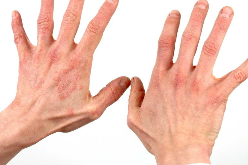 Средство применяют для лечения воспалительных болезней кожи 