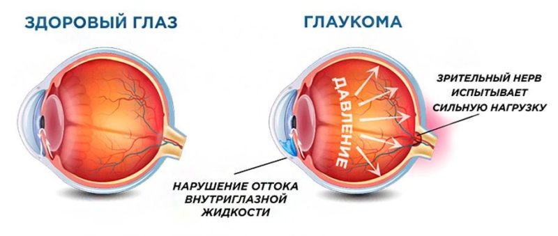 Описание симптомов глаукомы